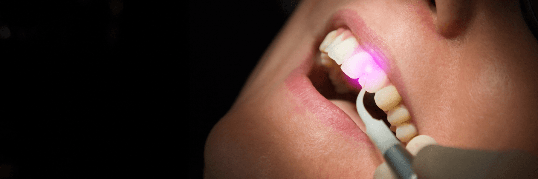 Laser Dentistry | Dentist